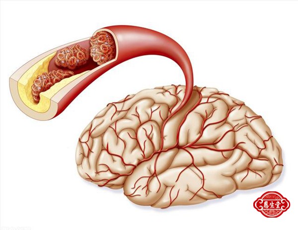 脑动脉硬化13.jpg