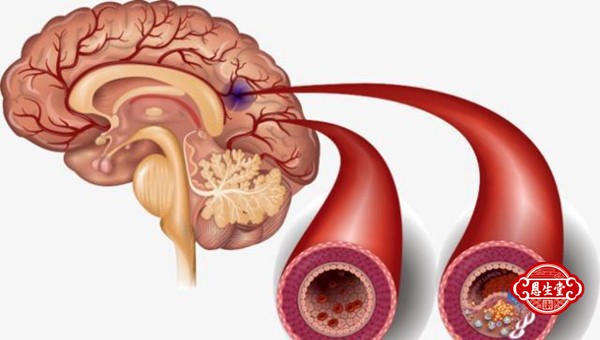 脑动脉硬化 (3)05.jpg