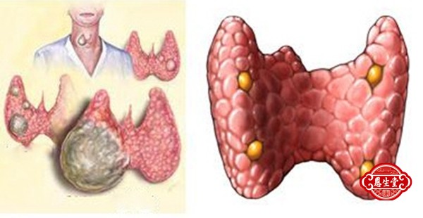 甲状腺 (3)4.jpg